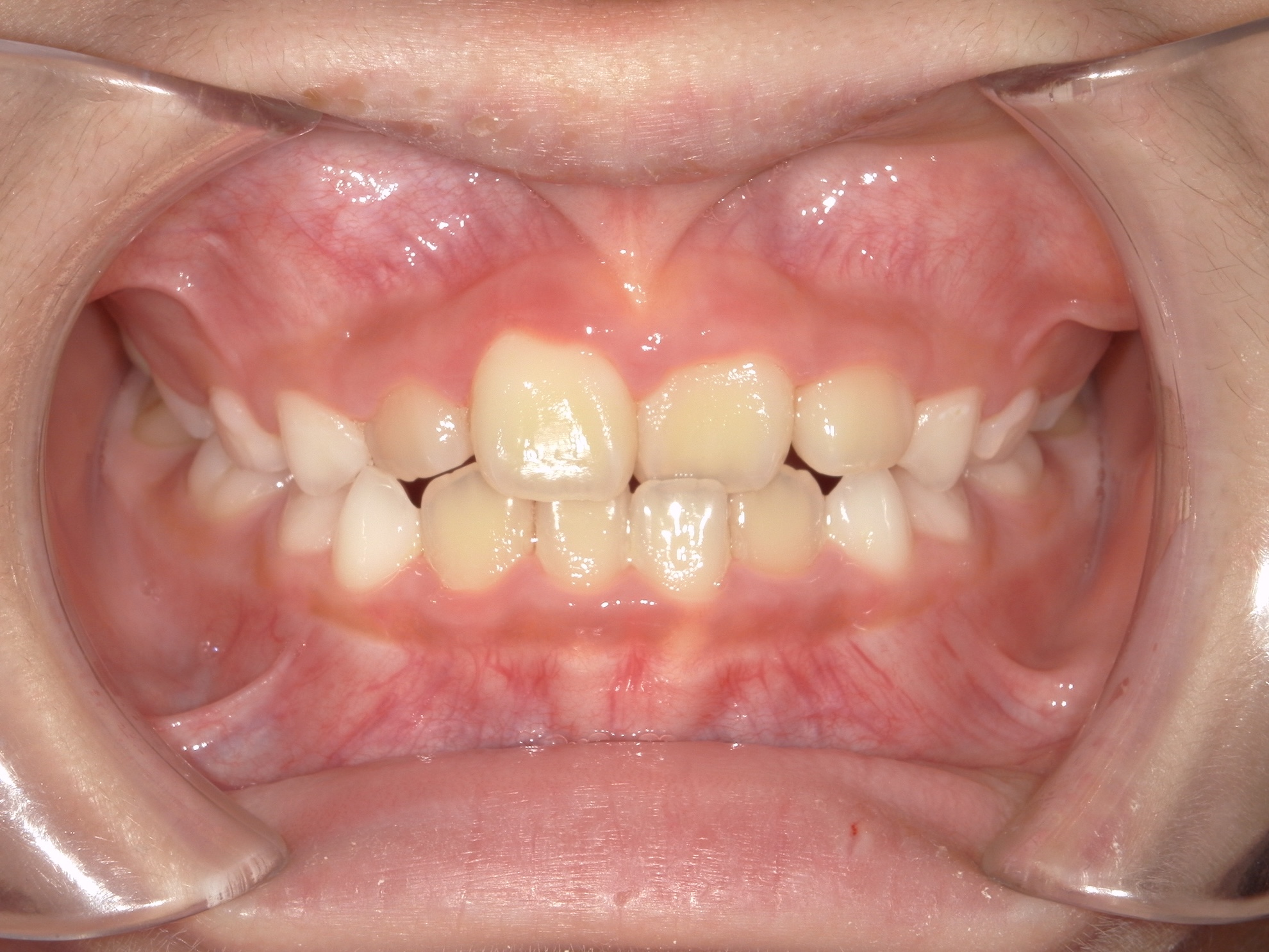 交差した歯並びの治療前