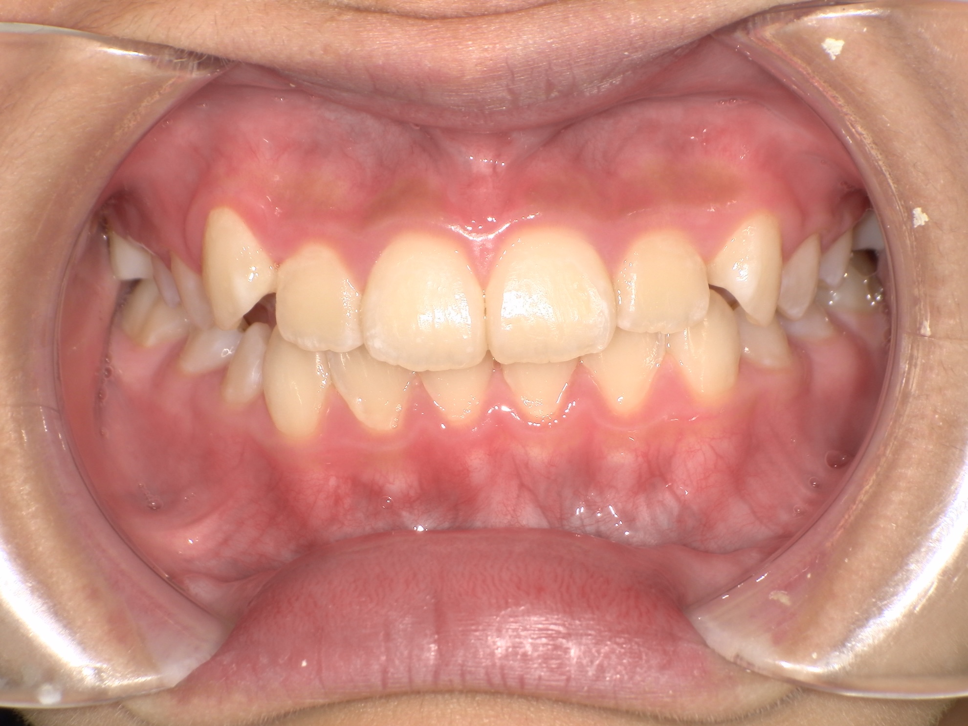 交差した歯並びの治療後