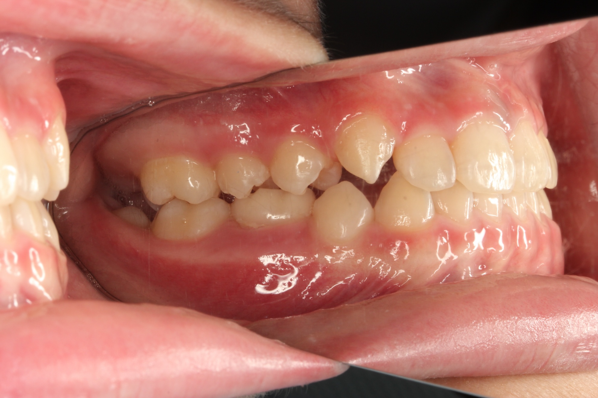 反対咬合の治療後